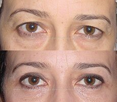 Blépharoplastie